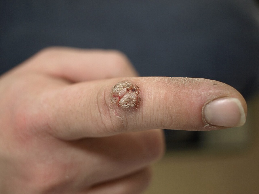 A rough, raised common wart on the side of a finger