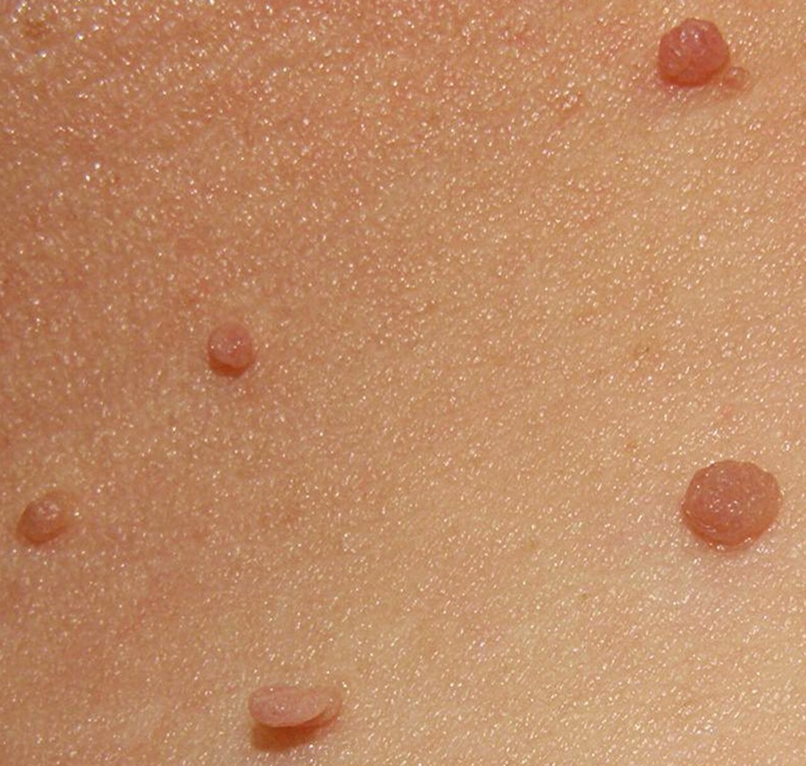 Several small, soft, skin coloured skin tags on the lower neck
