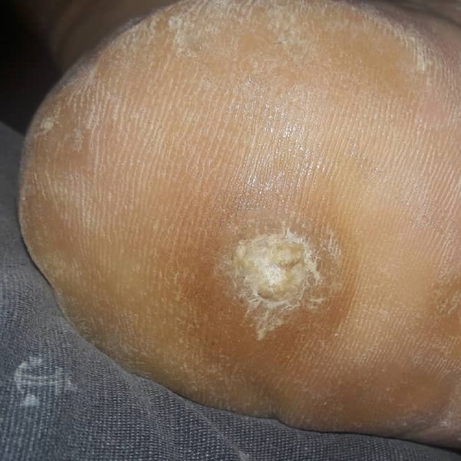 A verruca on the heel, flattened into the skin with a rough centre